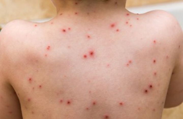 S300 Child With Chickenpox